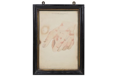 Lot 164 - A SET OF TEN LATE 19TH CENTURY DETAILED WATERCOLOURS OF HUMAN SKIN DISEASES
